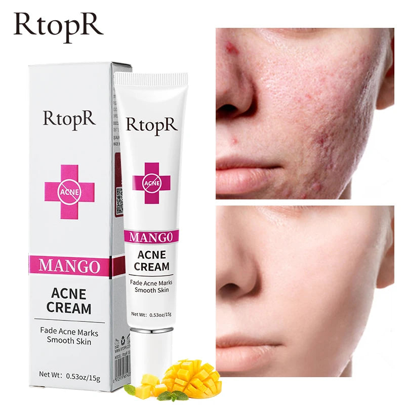 Acne treatment Cream remover Acne Mark Removal Mild Repair Damaged Skin Hydration Nourishment Rejuvenation Brightening Skin Care
