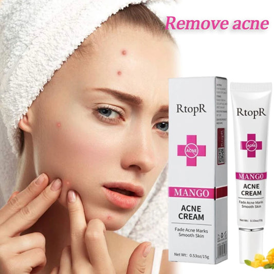 Acne treatment Cream remover Acne Mark Removal Mild Repair Damaged Skin Hydration Nourishment Rejuvenation Brightening Skin Care